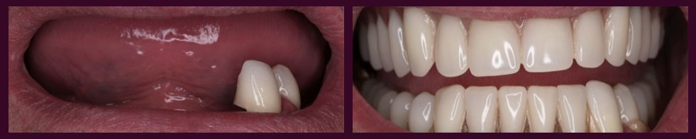 Young Dentures Before 
      And After Carlsbad CA 92013